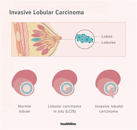 Invasive Ductal Carcinoma: What Is It, Risk Factors,, 55% OFF