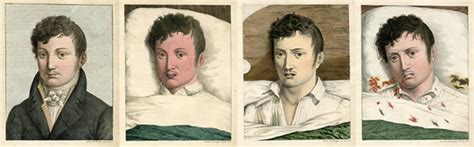 Four illustrations from 1819 showing the progress of yellow fever. | Image courtesy of the U.S ...