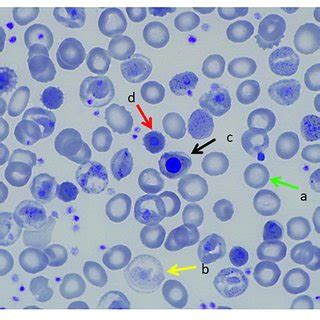 | Peripheral Blood Smear, Brilliant Cresyl Blue Stain. (a) Heinz bodies. | Download Scientific ...