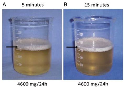 Albuminuria Causes Symptoms Treatment Albuminuria