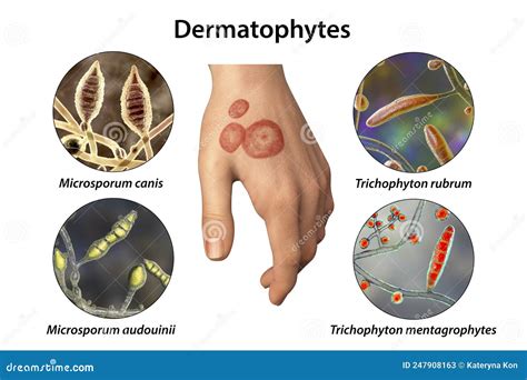 Hand Fungal Infection, Tinea Manuum, 3D Illustration Stock Illustration ...