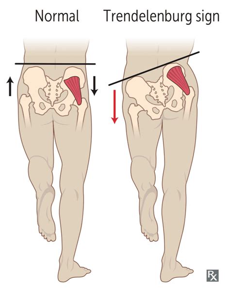 4 Gluteus Medius Exercises for Stronger, Balanced Hips - Precision Movement