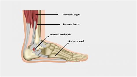 Best Exercises for Peroneal Tendonitis for Pain Relief