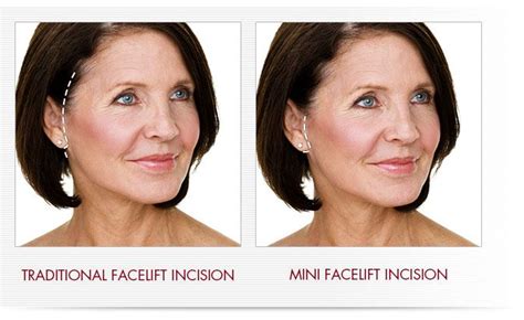 Facelift & Mini Facelift in Sacramento, CA | Wayne Yamahata, MD