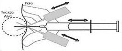 Fine Needle Aspiration Procedure and Contraindications | MedicoTips.Com