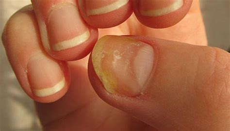 Nail Fungus - Los Gatos, CA: Los Gatos Dermatology