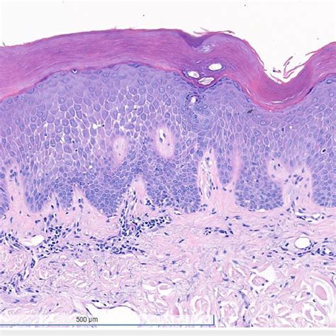 Histopathology of the skin biopsy. A 3 mm x 3 mm x 2 mm punch biopsy... | Download Scientific ...