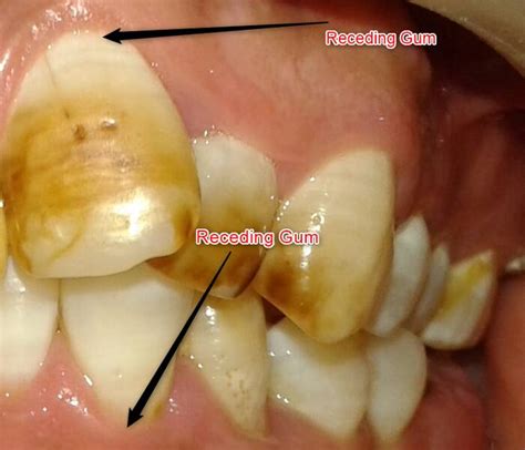 Is Gum Recession Reversible ? [Causes, Prevention & Symptoms]