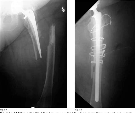 Figure 1 from Proximal femoral allograft treatment of Vancouver type-B3 periprosthetic femoral ...