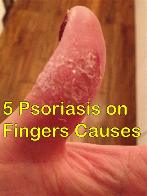 It's All About Psoriasis on Fingers Causes | Disfreeskin