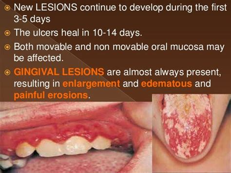 Primary herpetic gingivostomatitis