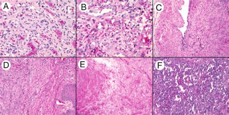 Histology. (A) Cutaneous hemangioma. (B) Epithelioid... | Download ...