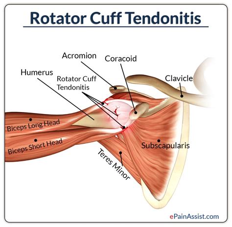 Rotator Cuff Tendonitis