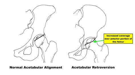 Fixing Hip Impingement – Squat University