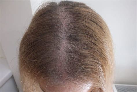 Telogen Effluvium Hair Loss | Doç.Dr.Ekrem Civas