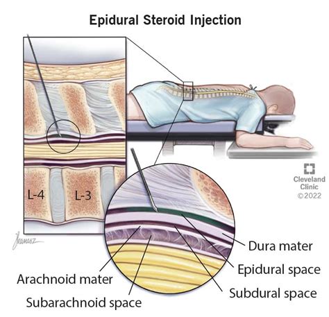 Epidural Steroid Injection (ESI): What It Is, Benefits,, 41% OFF