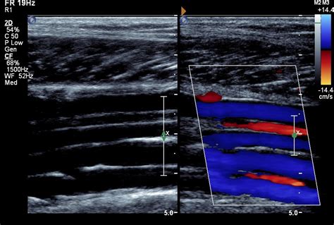 Leg DVT Normal - Ultrasoundpaedia | Ultrasound sonography, Vascular ...