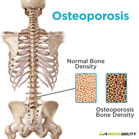 Osteoporosis in your Back & Spine | Symptoms, Causes, Treatments