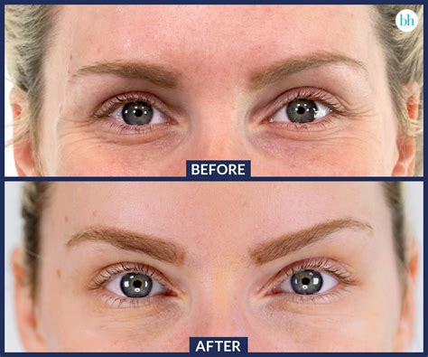 botox-before-and-after | Botox eyes, Botox before and after, Eyebrow lift botox