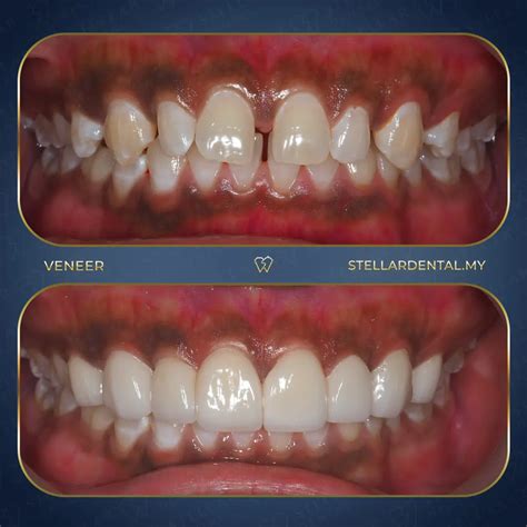 Teeth Veneers: Intro, Types, Price, Pros & Cons