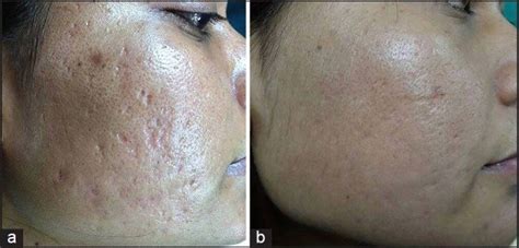 (a) Grade 3 acne scars; (b) Improvement in acne scars from Grade 3 to... | Download Scientific ...