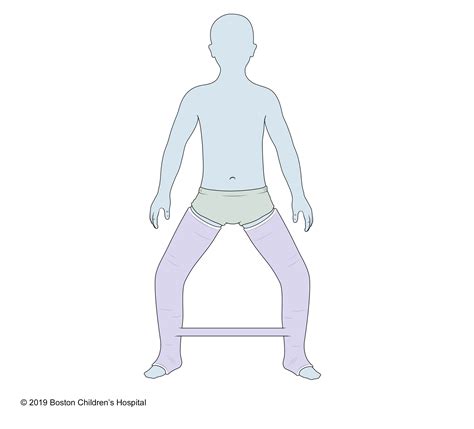 Types of Casts | Boston Children's Hospital