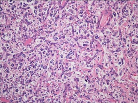 A paraganglioma consisting of cells arranged in nests (‘zellballen’)... | Download Scientific ...