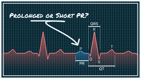 QALY | PR Interval on Your Watch ECG – Short, Normal, and Prolonged