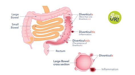 Diverticulitis Vs Diverticulosis