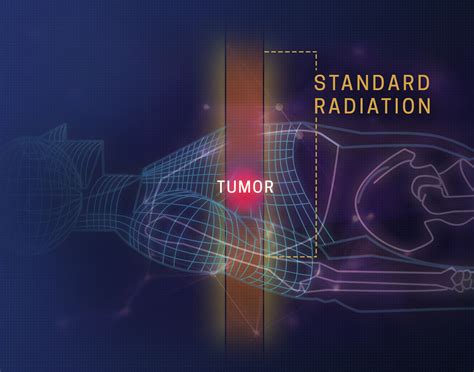 What is Proton Therapy - How Does It Work - California Protons