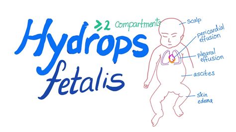 Hydrops fetalis - YouTube