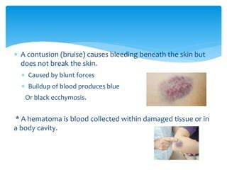 Soft-Tissue Injuries | PPT