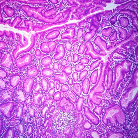 Villous Adenoma Colon, Microscope Slide | Carolina Biological Supply