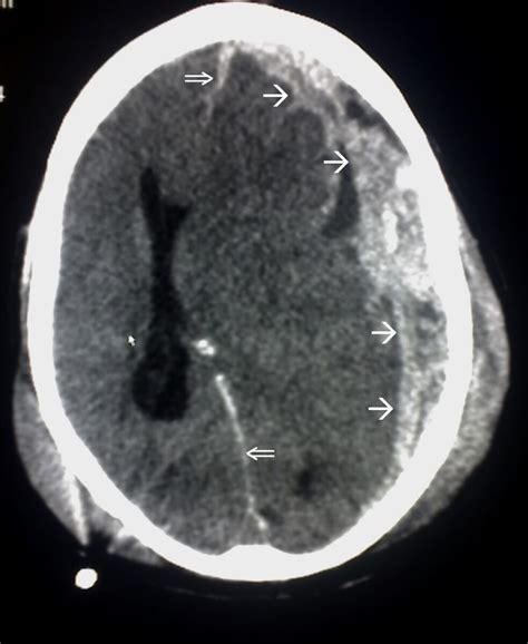 Subdural Hemorrhage | Concise Medical Knowledge