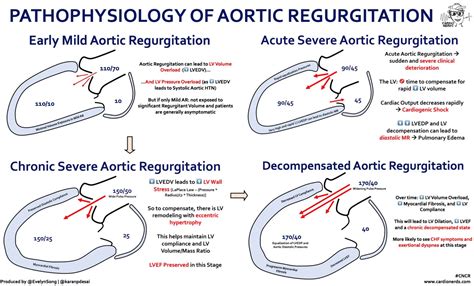 Aortic Regurgitation Pathophysiology