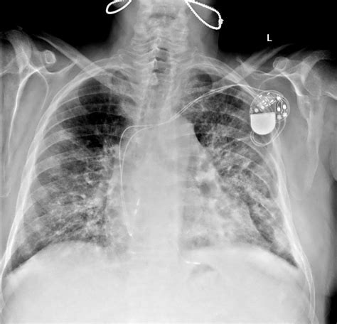 Legionella pneumophila - Microbiology - Medbullets Step 1