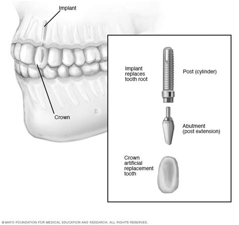 Dental implant surgery - Mayo Clinic