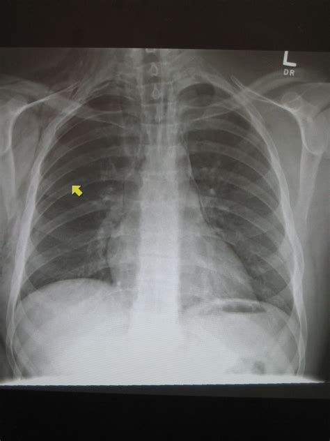 Pneumomediastinum chest x ray - wikidoc