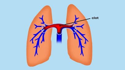 What is Saddle Pulmonary Embolism - Definition, Symptoms, Causes, Treatment - Health Care Tips ...