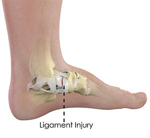 Ankle Ligament Injury Sydney, NSW | Ankle Reconstruction Surgery Randwick