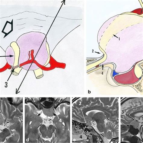 Operative view of a tuberculum sellae meningioma resection through an ...