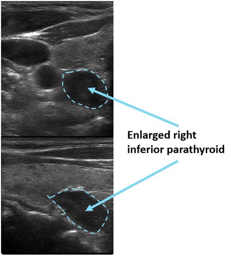 Parathyroid Imaging and Ultrasounds | Saint John’s Cancer Institute