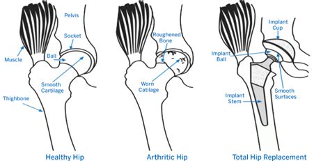 Hip Replacement Surgery: Procedure, Types and Risks | HSS