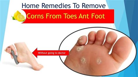 Foot Corn Removal Remedies – Foot Care Tips