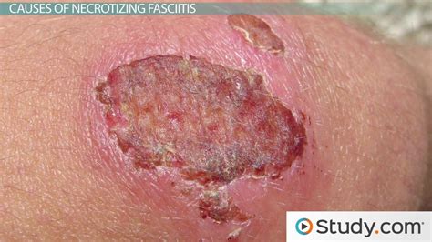 Flesh Eating Bacteria | Symptoms, Stages & Treatment - Lesson | Study.com