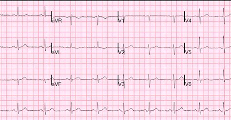 Dr. Smith's ECG Blog: A Case of Clinical Unstable Angina in the ED