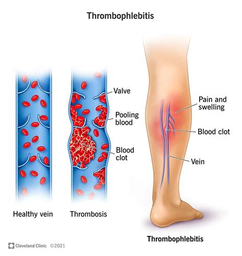 Thrombophlebitis: Causes, Symptoms and Treatment