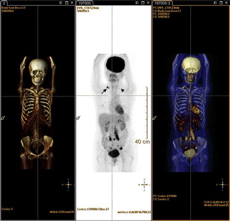 Pet Ct Scan Machine