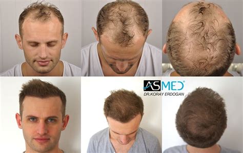 Norwood 5 Hair Transplantation Results | Asmed Hair Transplant