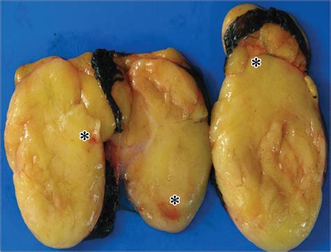 Fatty Tumor Compressing the Heart | Cardiology | JAMA Surgery | JAMA Network